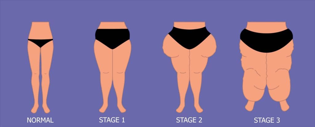 Stages of Lipedema