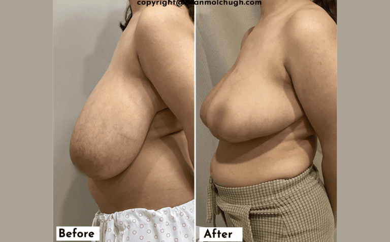 Breast Reduction