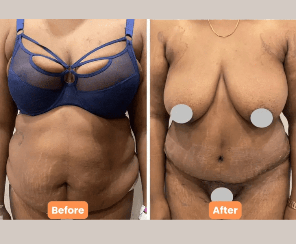 Tummy Tuck