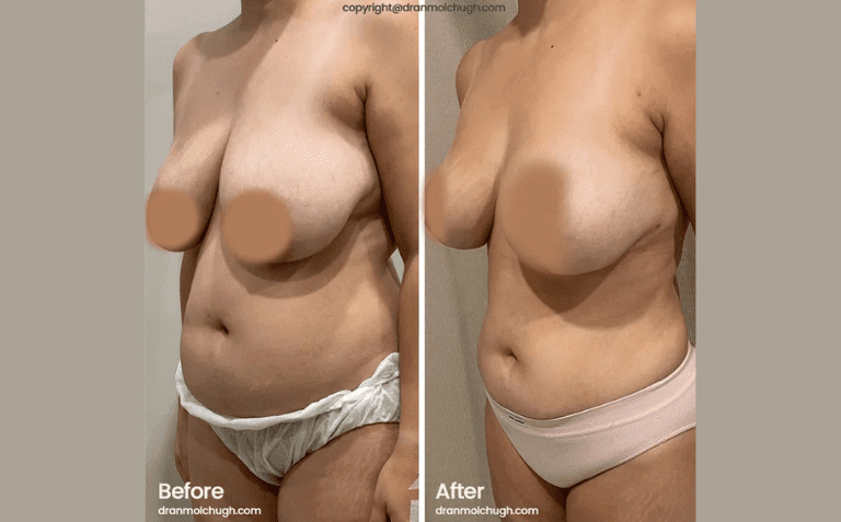 Breast Reduction with Liposuction