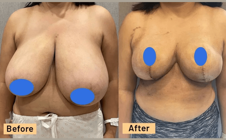 35-44 year old woman treated with Breast Reduction