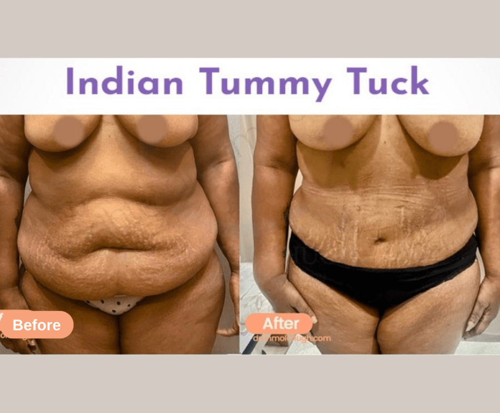 Indian Tummy Tuck