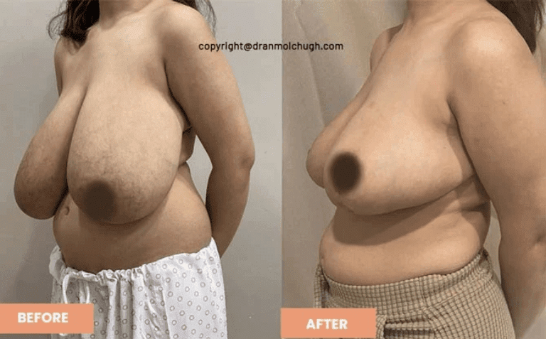 Breast Reduction