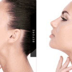 Before and after jaw implant surgery results – Cost-effective jawline enhancement in India