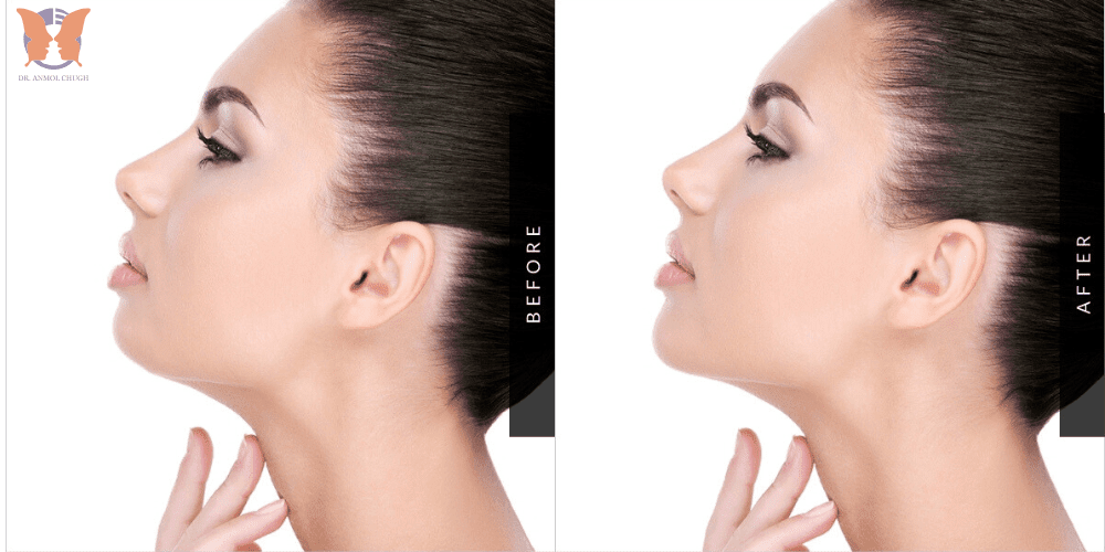 Before and after jaw implant surgery results – Cost-effective jawline enhancement in India
