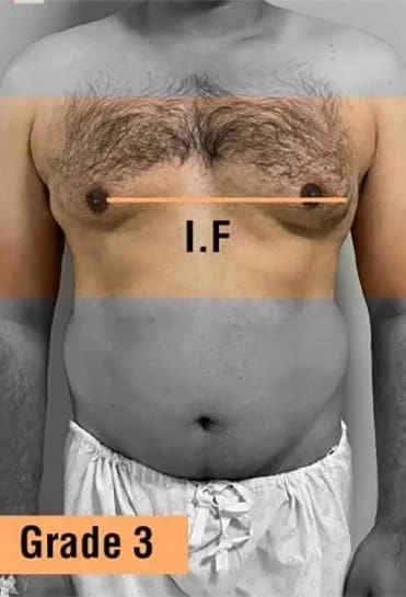 Gynecomastia Grade 3
