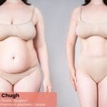 Before and after natural-looking tummy tuck results with subtle contouring