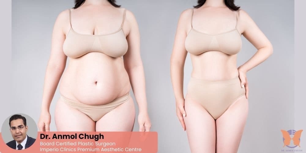 Before and after natural-looking tummy tuck results with subtle contouring