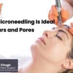 7 Reasons Microneedling Is Ideal for Acne Scars and Pores