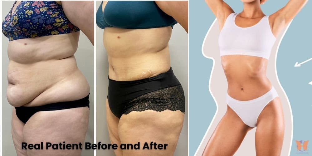 Tummy tuck results timeline – Before and after transformation showing realistic recovery stages