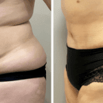 Natural Tummy Tuck Results