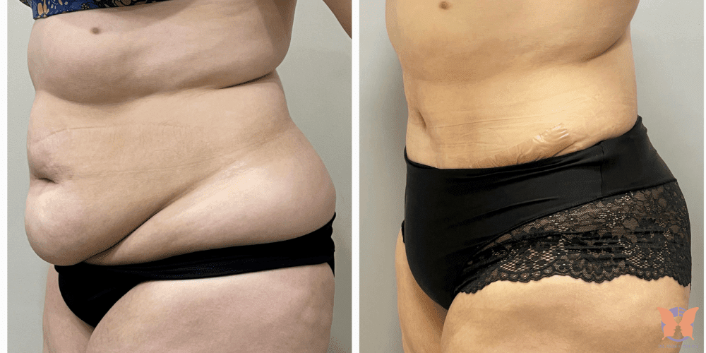 Natural Tummy Tuck Results