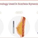 Scarless gynecomastia surgery in India using advanced science and technology for natural chest contour