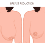 Natural breast reduction results – balanced and proportionate breast shape for enhanced confidence