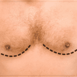Safe gynecomastia surgery performed with advanced techniques and expert care