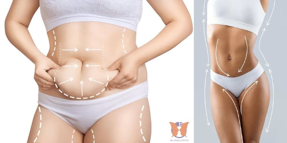 Liposuction Is Not a Shortcut - It’s a Shape Refinement