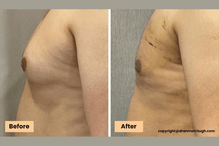 Grade 2 Gynecomastia