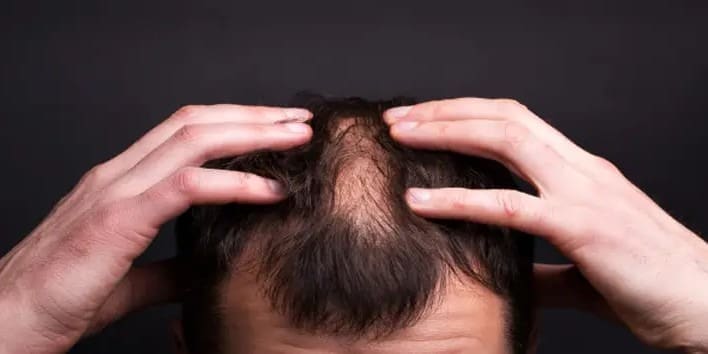 5-things you must do after Hair Transplant Treatment