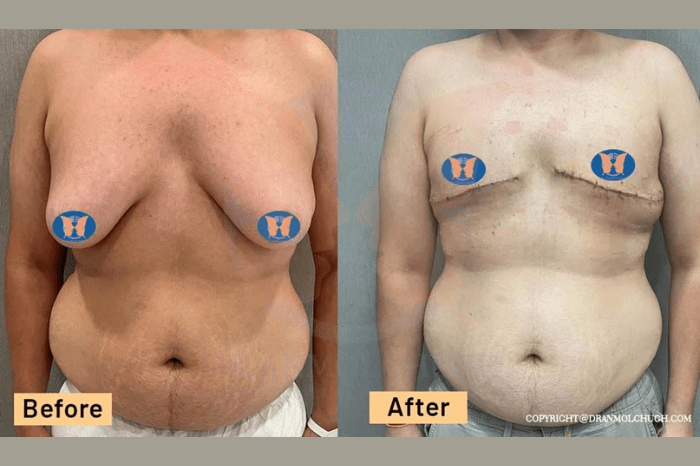 Grade 4 gynecomastia