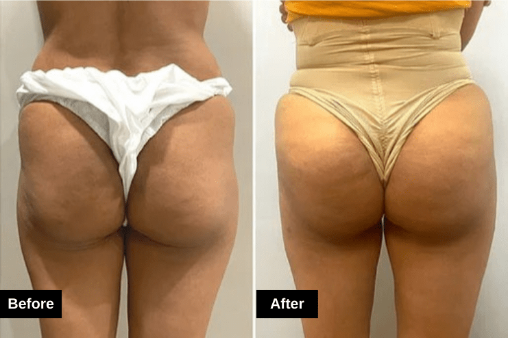 Brazilian Butt Lift Before and After