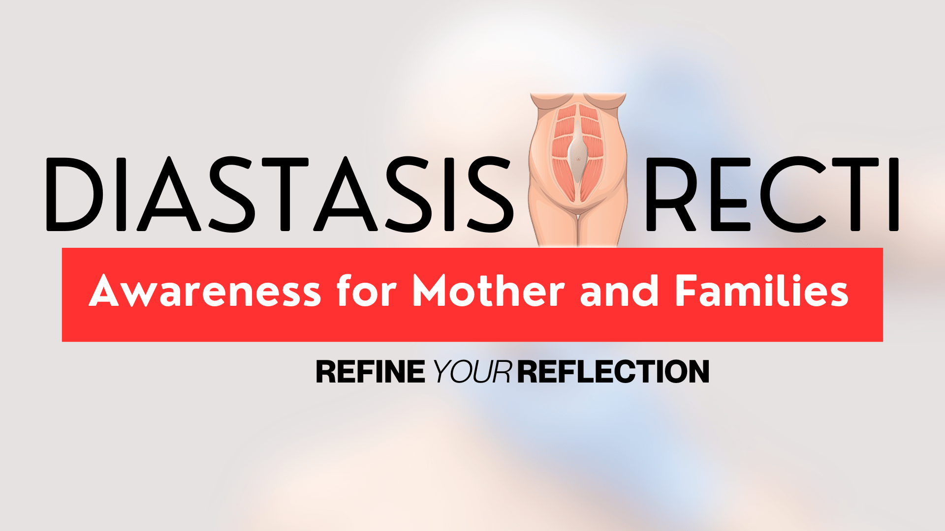 Diastasis recti