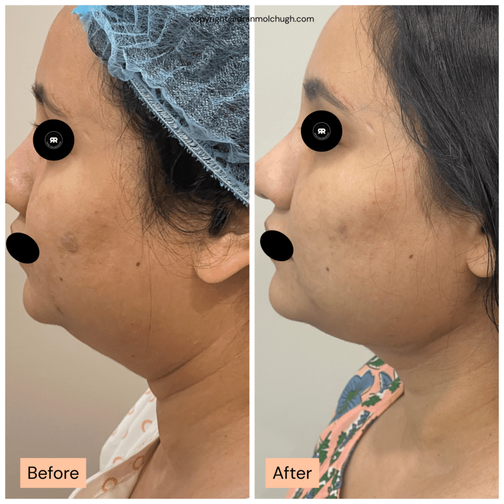 45-54 year old woman treated with Chin Liposuction