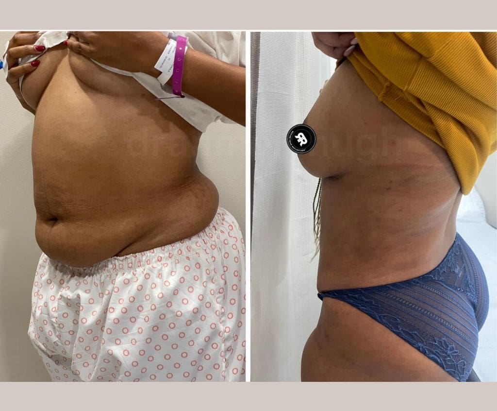 Tummy tuck with 360 liposuction 38 year old female 2 months follow up