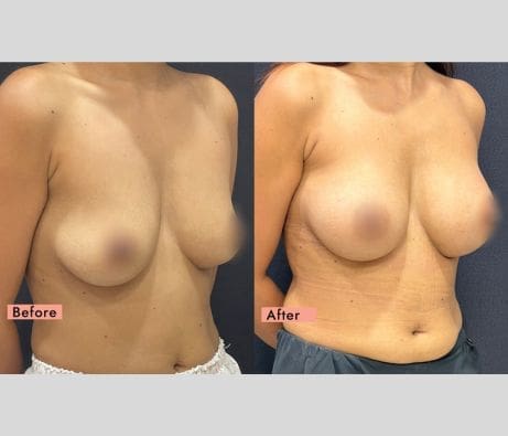 42-year-old woman, 2 months post breast augmentation with implants.
