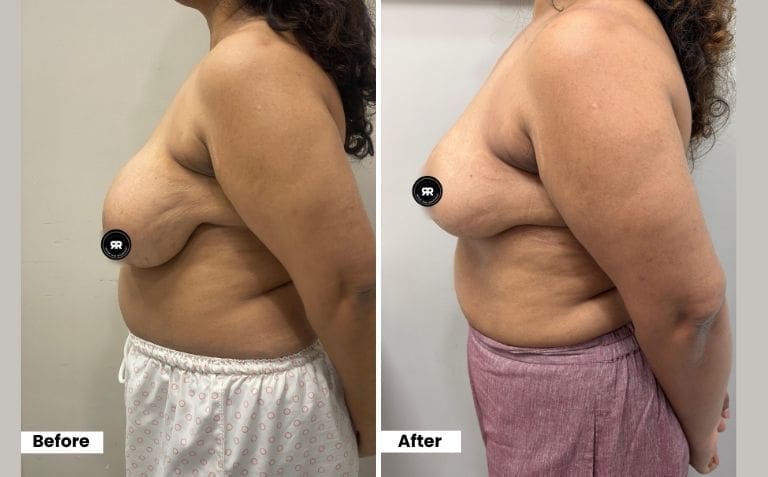 Breast Reduction 40-year-old 8 months post op